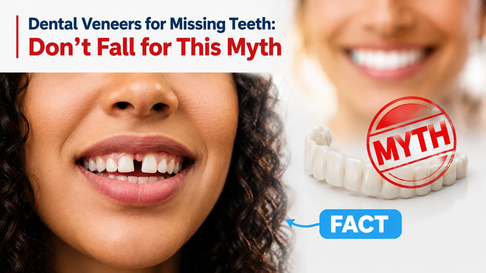 Dental Veneers for Missing Teeth